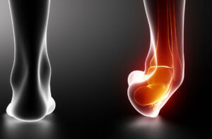 Sprain or Strain, What Are You Dealing With?