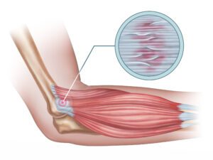 What is the difference between tendinitis and tendinosis?