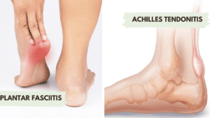 Plantar Fasciitis vs. Achilles Tendonitis