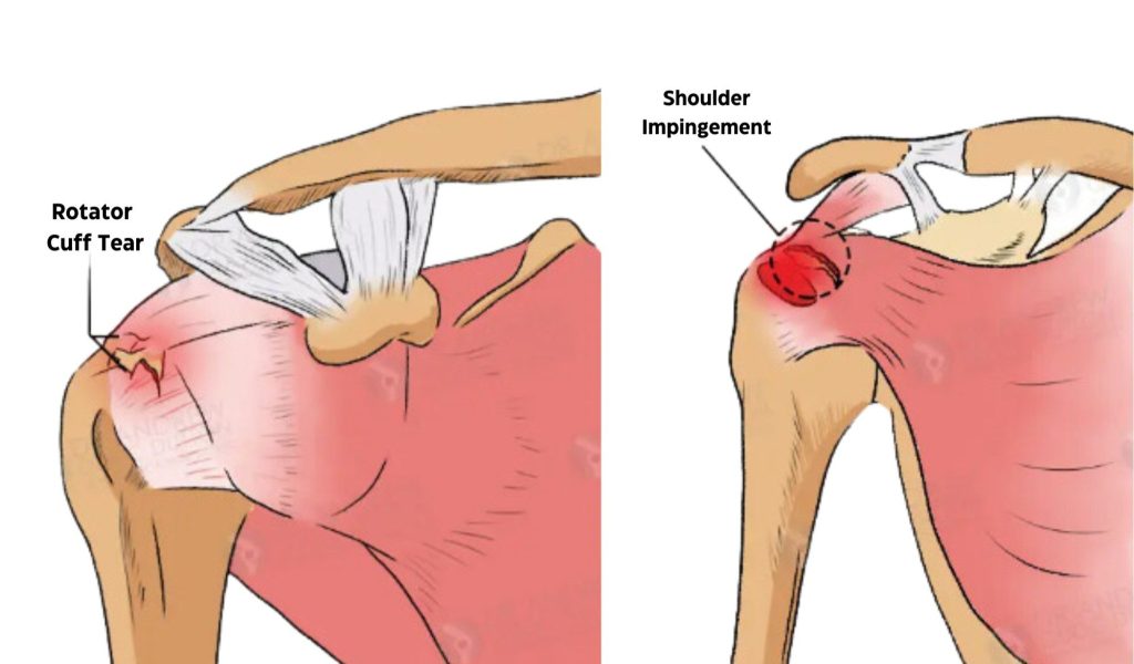 Rotator cuff tears and impingement syndrome, what is the difference?