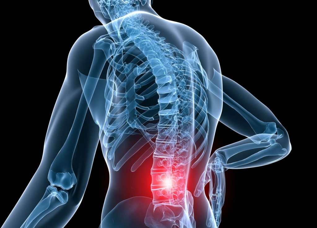 Not All Low Back Pain is a Disc Herniation